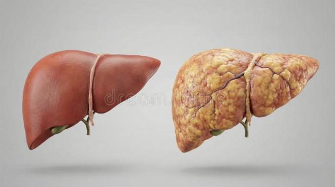 Sơ đồ so sánh gan khỏe mạnh và gan bị xơ hóa do tác động của việc uống rượu bia kéo dài